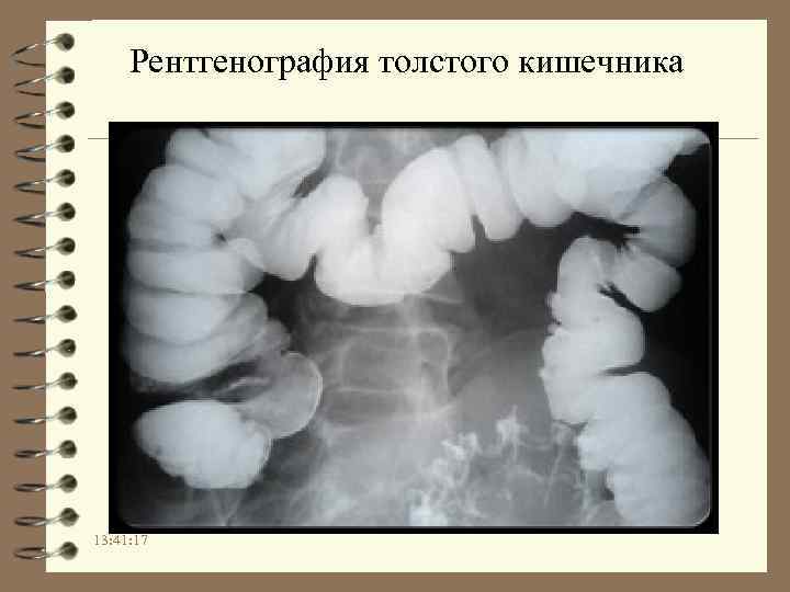 Рентгенография толстого кишечника 13: 41: 17 