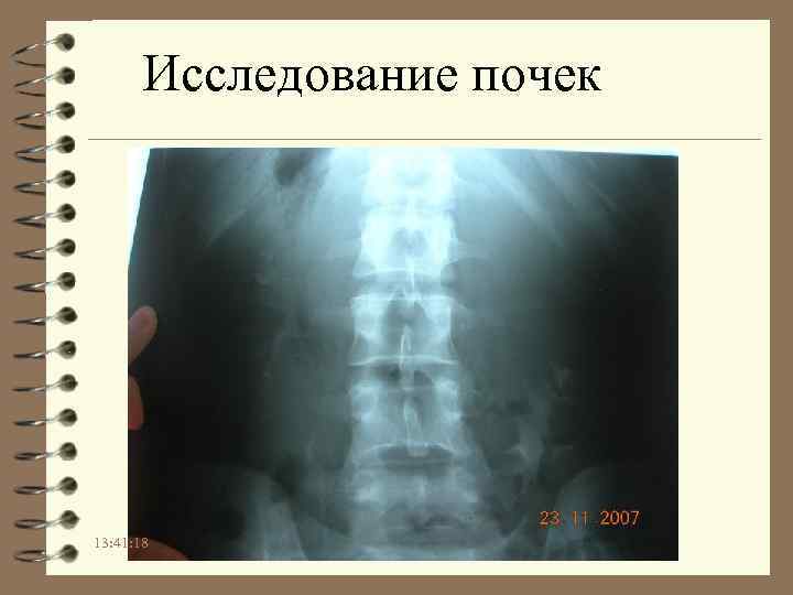 Исследование почек 13: 41: 18 