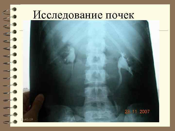 Исследование почек 13: 41: 19 
