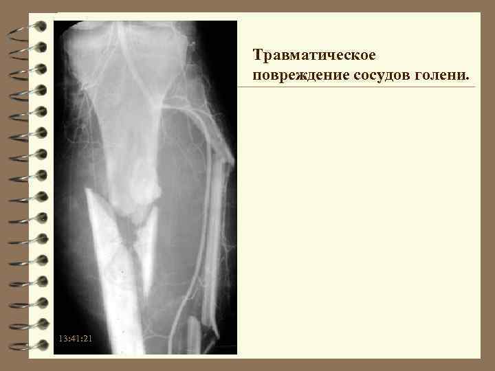 Травматическое повреждение сосудов голени. 13: 41: 21 