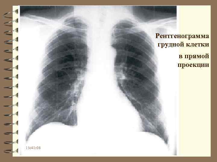 Рентгенограмма грудной клетки в прямой проекции 13: 41: 08 