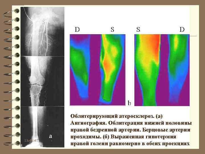 13: 41: 47 Облитерирующий атеросклероз. (а) Ангиография. Облитерация нижней половины правой бедренной артерии. Берцовые