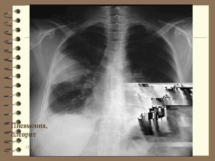 Пневмония, плеврит 13: 41: 09 