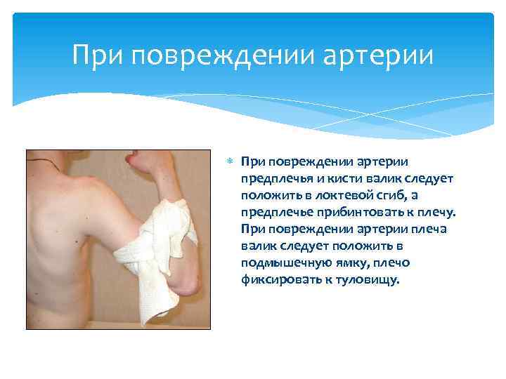При повреждении артерии предплечья и кисти валик следует положить в локтевой сгиб, а предплечье