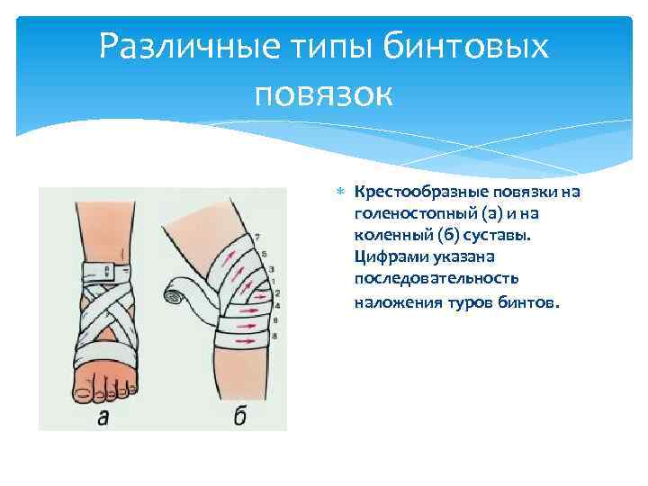 Типы бинтовых повязок рисунок