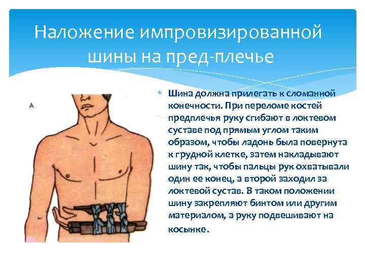 Наложение импровизированной шины на пред плечье Шина должна прилегать к сломанной конечности. При переломе