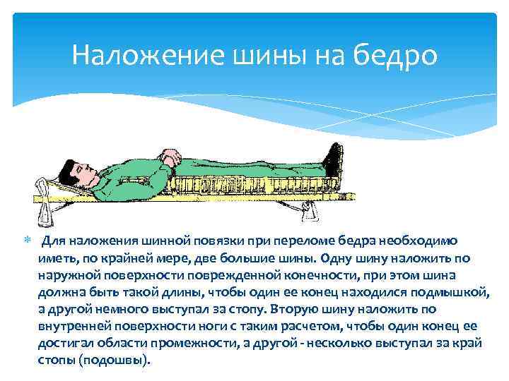 Наложение шины на бедро Для наложения шинной повязки при переломе бедра необходимо иметь, по