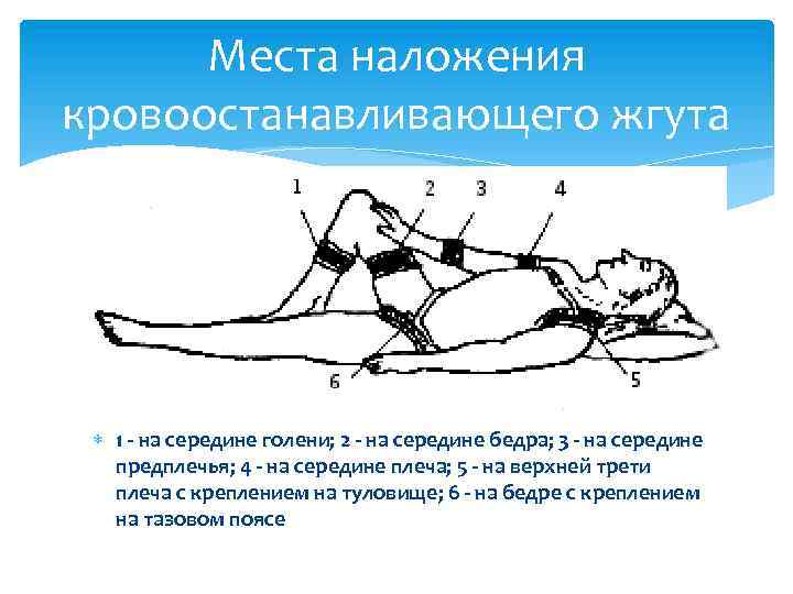 Места наложения кровоостанавливающего жгута 1 - на середине голени; 2 - на середине бедра;