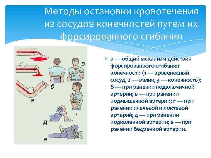 Методы остановки кровотечения из сосудов конечностей путем их форсированного сгибания а — общий механизм