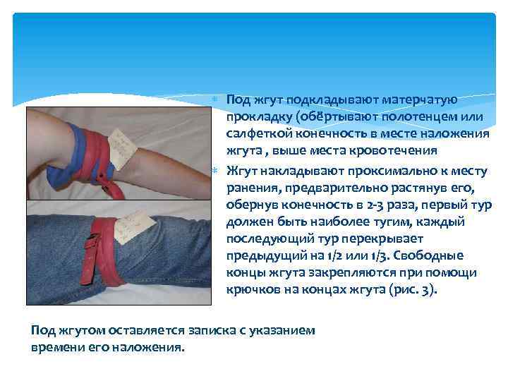  Под жгут подкладывают матерчатую прокладку (обёртывают полотенцем или салфеткой конечность в месте наложения