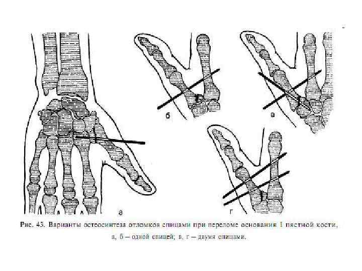 Операция на большом пальце руки. Остеосинтез 1 пястной кости. Перелом 1 пястной кости остеосинтез спицами. Перелом пястной кости остеосинтез. Перелом 1 пястной кости большого пальца.