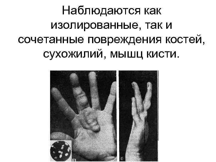 Наблюдаются как изолированные, так и сочетанные повреждения костей, сухожилий, мышц кисти. 