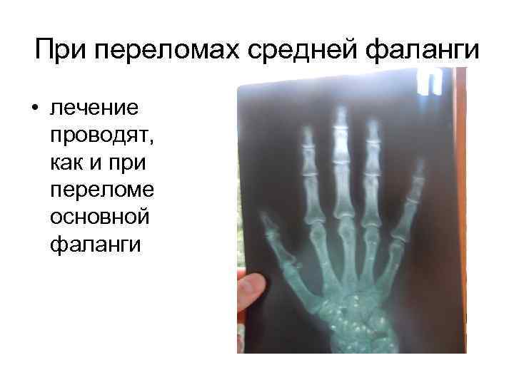 При переломах средней фаланги • лечение проводят, как и при переломе основной фаланги 