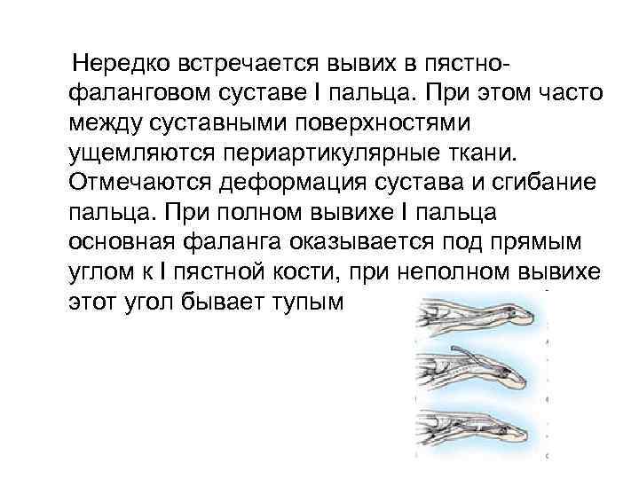Нередко встречается вывих в пястнофаланговом суставе I пальца. При этом часто между суставными поверхностями