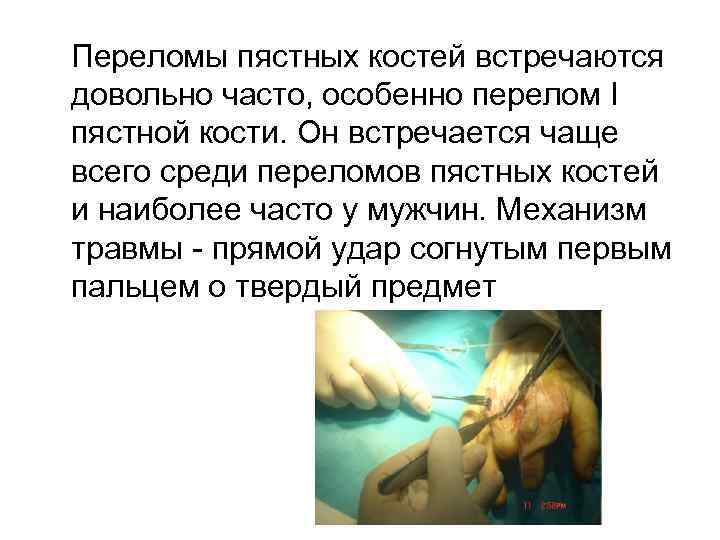 Переломы пястных костей встречаются довольно часто, особенно перелом I пястной кости. Он встречается чаще