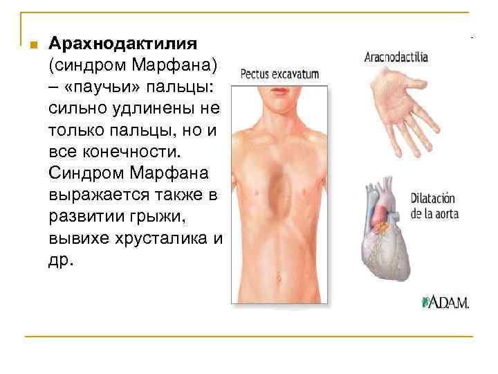 n Арахнодактилия (синдром Марфана) – «паучьи» пальцы: сильно удлинены не только пальцы, но и