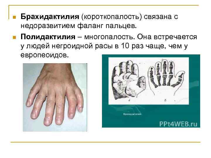 n n Брахидактилия (короткопалость) связана с недоразвитием фаланг пальцев. Полидактилия – многопалость. Она встречается