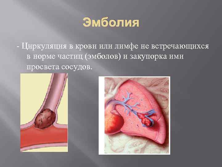 Эмболия - Циркуляция в крови или лимфе не встречающихся в норме частиц (эмболов) и