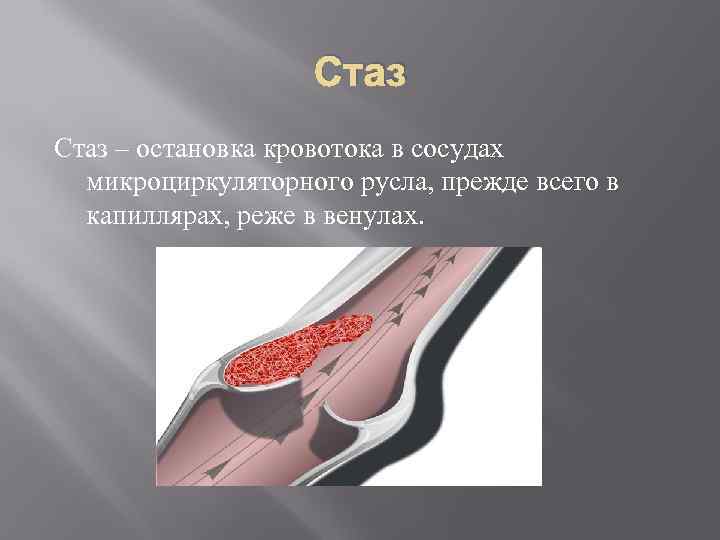 Стаз – остановка кровотока в сосудах микроциркуляторного русла, прежде всего в капиллярах, реже в