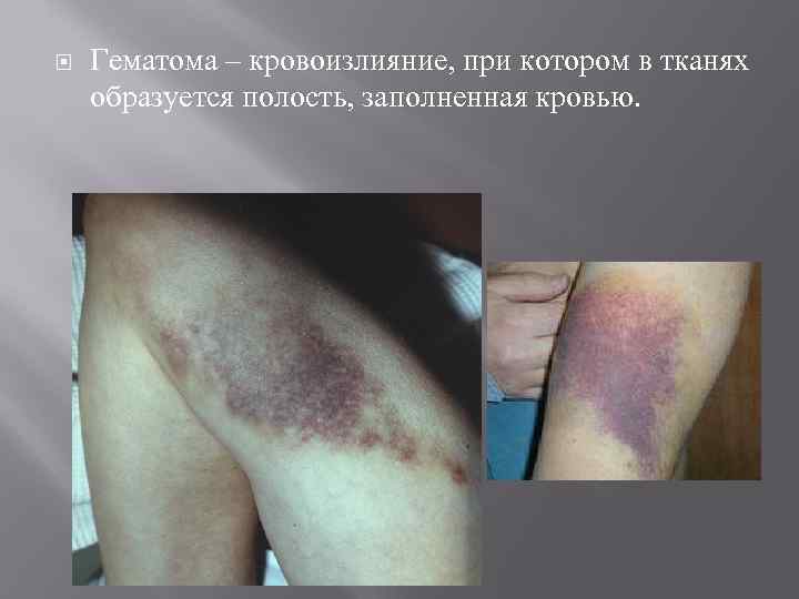  Гематома – кровоизлияние, при котором в тканях образуется полость, заполненная кровью. 