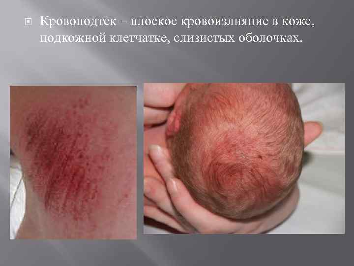  Кровоподтек – плоское кровоизлияние в коже, подкожной клетчатке, слизистых оболочках. 