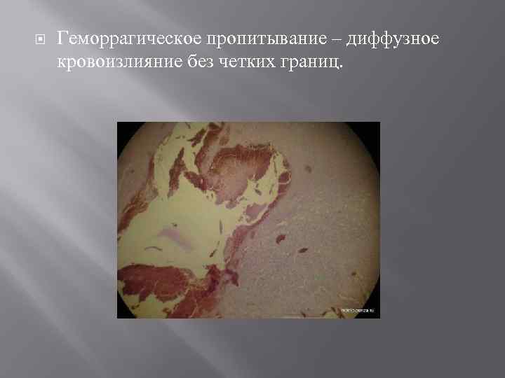 Геморрагическое пропитывание – диффузное кровоизлияние без четких границ. 