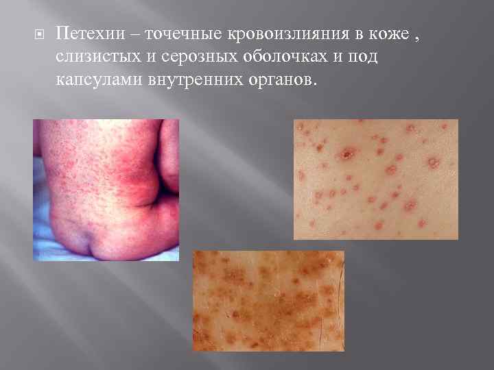  Петехии – точечные кровоизлияния в коже , слизистых и серозных оболочках и под
