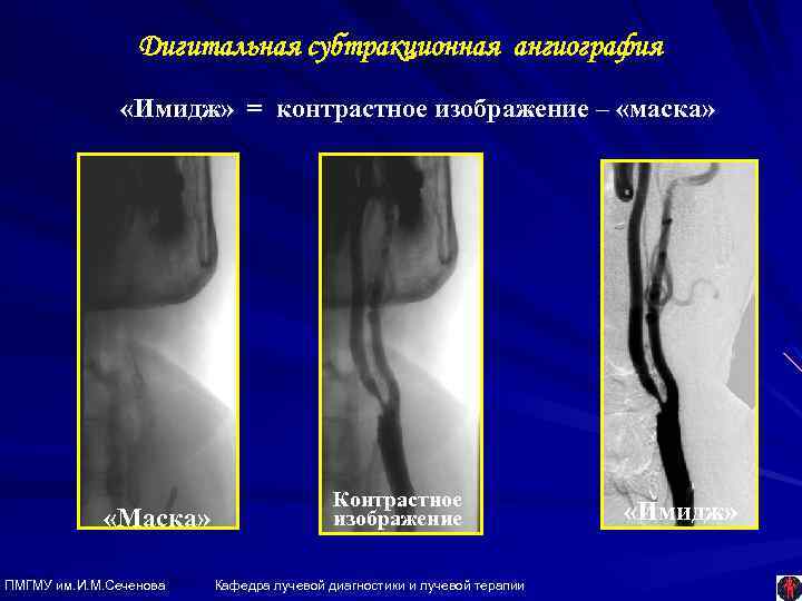 Дигитальная субтракционная ангиография «Имидж» = контрастное изображение – «маска» «Маска» ПМГМУ им. И. М.