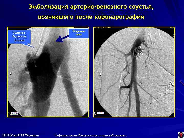 Эмболизация артерио-венозного соустья, возникшего после коронарографии Катетер в бедренной артерии ПМГМУ им. И. М.