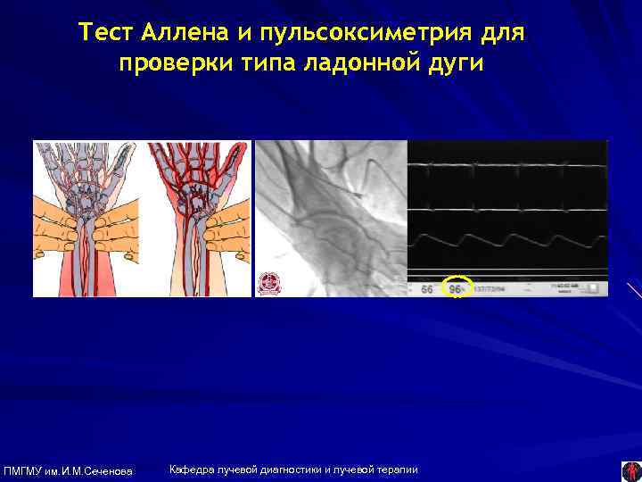 Тест Аллена и пульсоксиметрия для проверки типа ладонной дуги ПМГМУ им. И. М. Сеченова