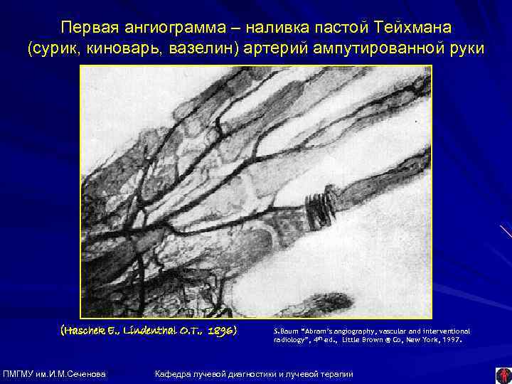Первая ангиограмма – наливка пастой Тейхмана (сурик, киноварь, вазелин) артерий ампутированной руки (Haschek E.