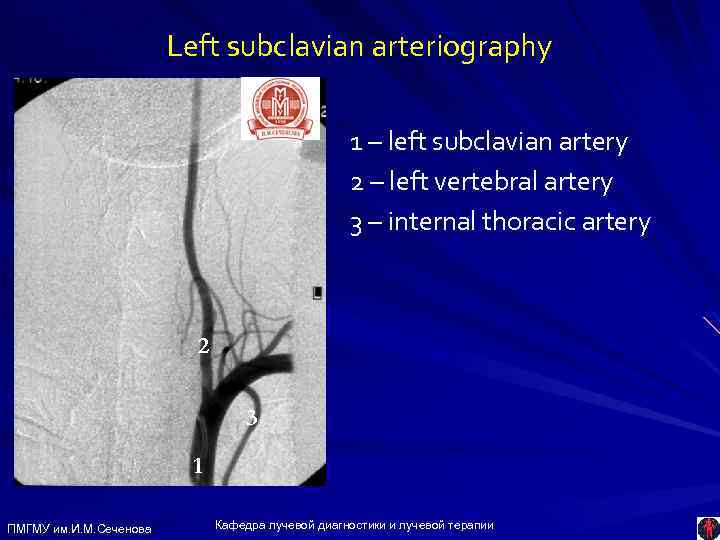 Left subclavian arteriography 1 – left subclavian artery 2 – left vertebral artery 3