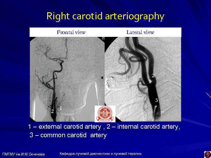 Right carotid arteriography Frontal view Lateral view 1 2 1 1 2 3 1