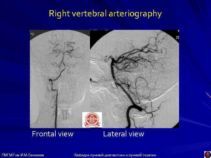 Right vertebral arteriography Frontal view ПМГМУ им. И. М. Сеченова Lateral view Кафедра лучевой