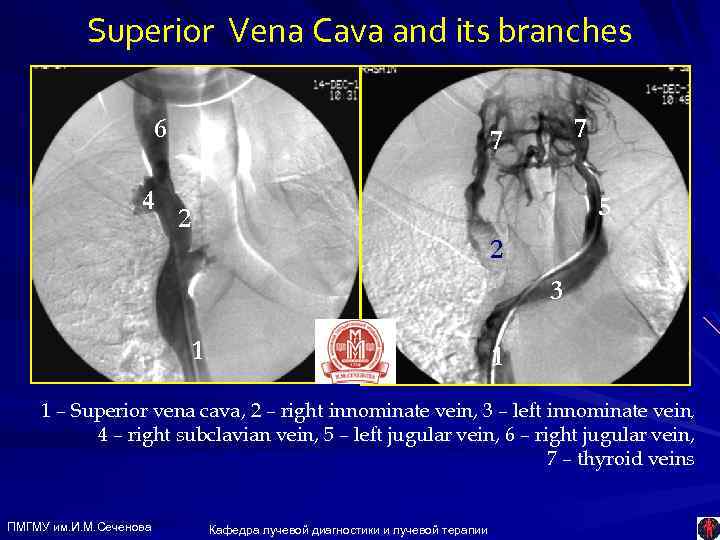 Superior Vena Cava and its branches 6 4 7 7 5 2 2 3