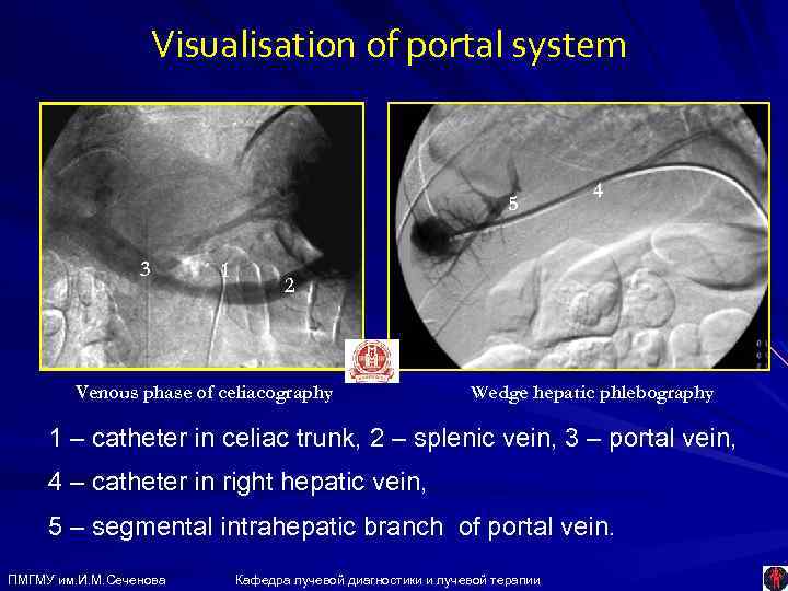 Visualisation of portal system 5 3 1 4 2 Venous phase of celiacography Wedge