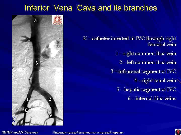 Inferior Vena Cava and its branches 5 К – catheter inserted in IVC through