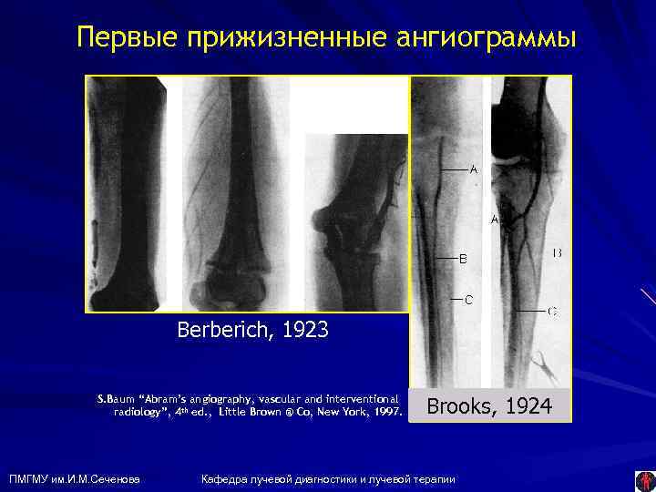 Первые прижизненные ангиограммы Berberich, 1923 S. Baum “Abram’s angiography, vascular and interventional radiology”, 4