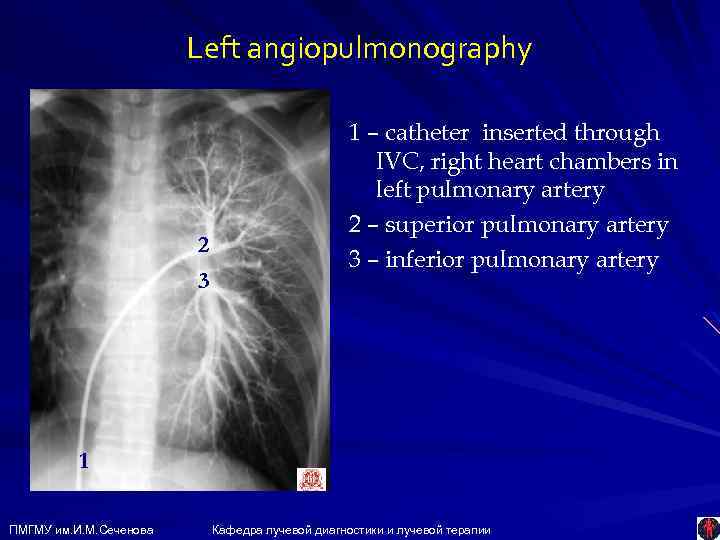 Left angiopulmonography 2 3 1 – catheter inserted through IVC, right heart chambers in