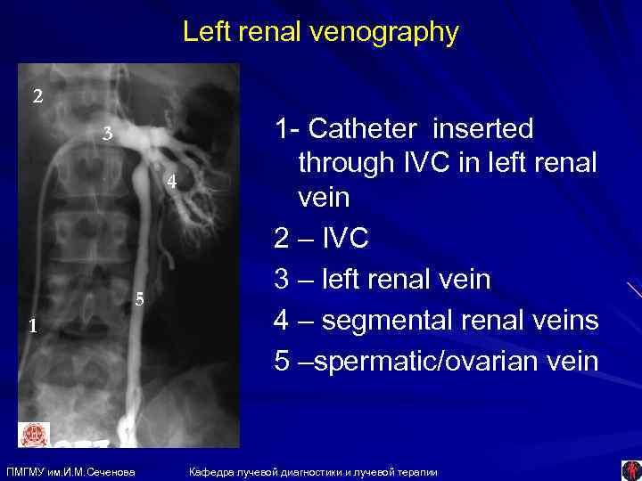 Left renal venography 2 3 4 5 1 ПМГМУ им. И. М. Сеченова 1