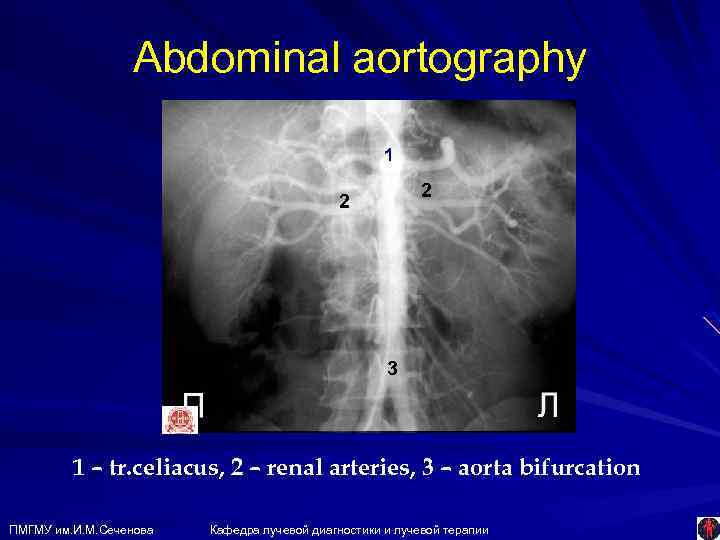 Abdominal aortography 1 1 2 2 3 3 1 – tr. celiacus, 2 –