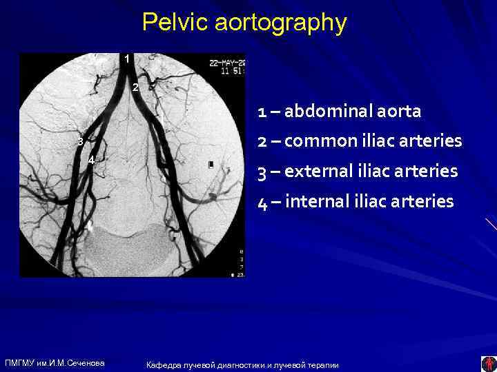 Pelvic aortography 1 2 1 – abdominal aorta 2 – common iliac arteries 3
