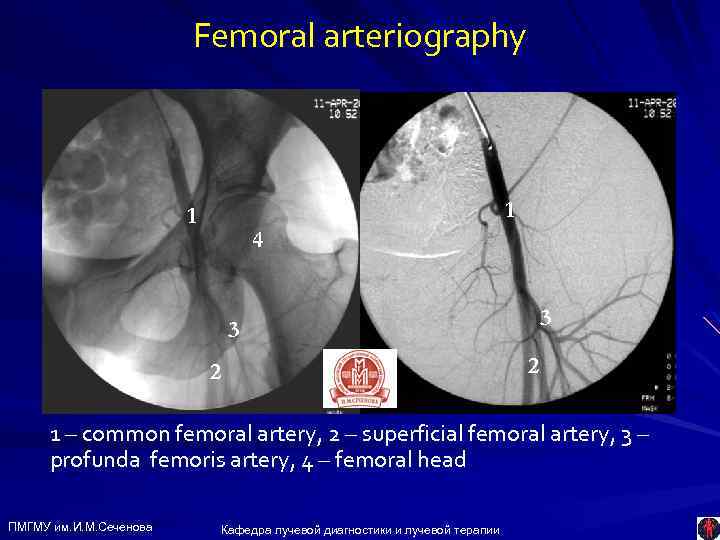 Femoral arteriography 1 1 4 3 3 2 2 1 – common femoral artery,