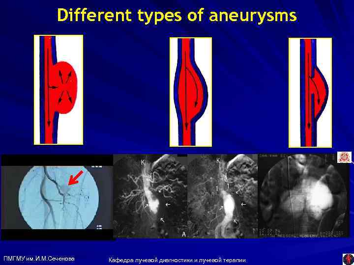 Different types of aneurysms Saccular aneurysm ПМГМУ им. И. М. Сеченова Кафедра лучевой диагностики