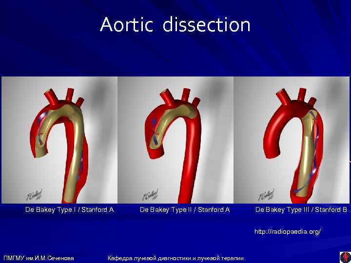 Aortic dissection De Bakey Type I / Stanford A De Bakey Type III /