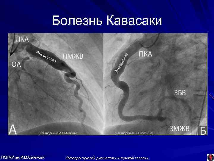 Болезнь Кавасаки ПМГМУ им. И. М. Сеченова Кафедра лучевой диагностики и лучевой терапии 