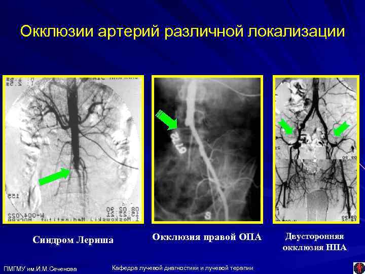 Окклюзия справа. Синдром окклюзии артерии. Ангиограмма больного с синдромом Лериша.. Окклюзия подключичной артерии.