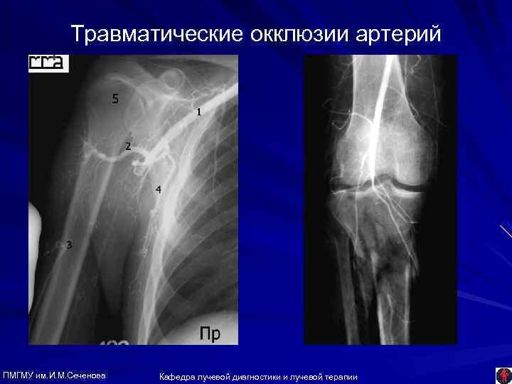 Травматические окклюзии артерий ПМГМУ им. И. М. Сеченова Кафедра лучевой диагностики и лучевой терапии