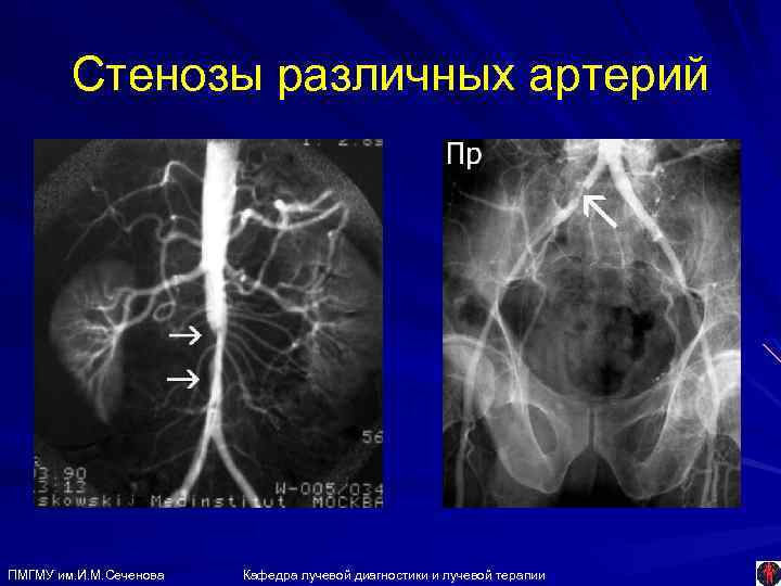 Стенозы различных артерий ПМГМУ им. И. М. Сеченова Кафедра лучевой диагностики и лучевой терапии
