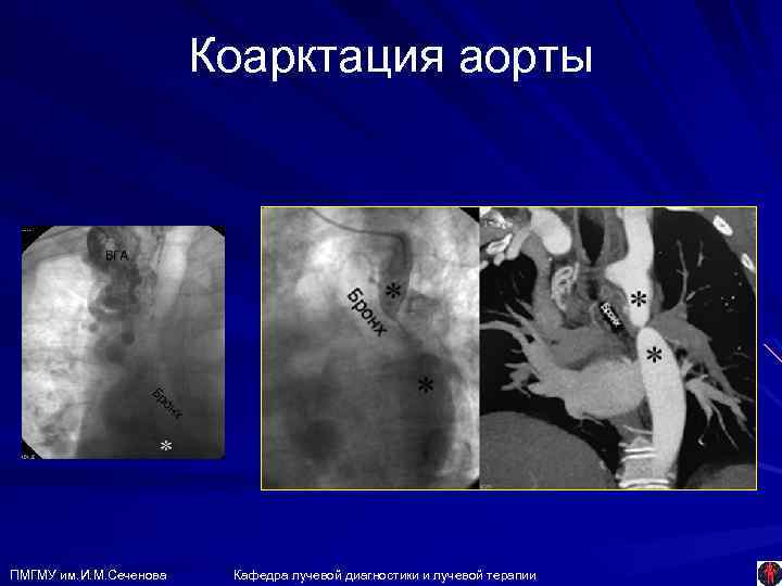 Коарктация аорты ПМГМУ им. И. М. Сеченова Кафедра лучевой диагностики и лучевой терапии 